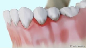 Parodontite et formation d'une poche parodontale